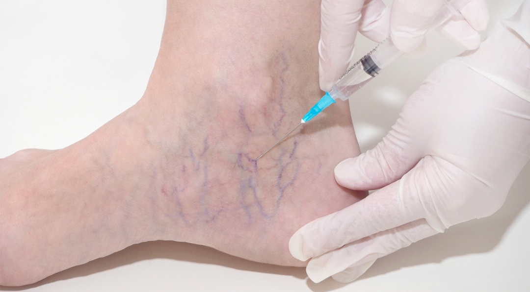 Sclerotherapy-3